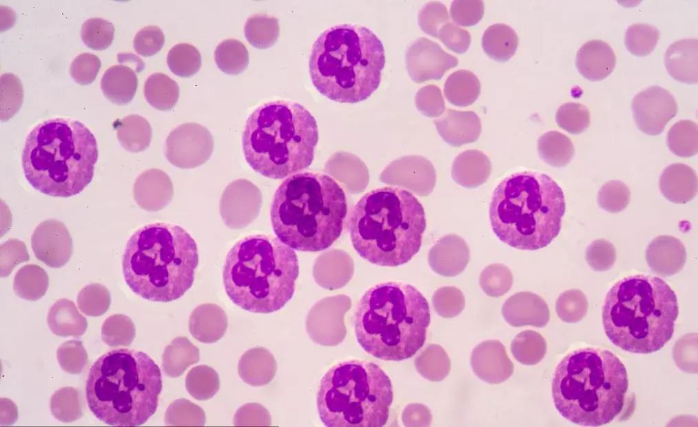 警惕！东莞女子确诊甲亢后服药治疗，一场小“感冒”却险些丧命！医生提醒······