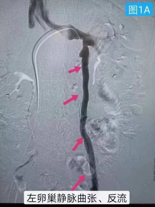 淄博哪家医院肺栓塞做的好,淄博中心医院治疗肠系膜动脉栓塞