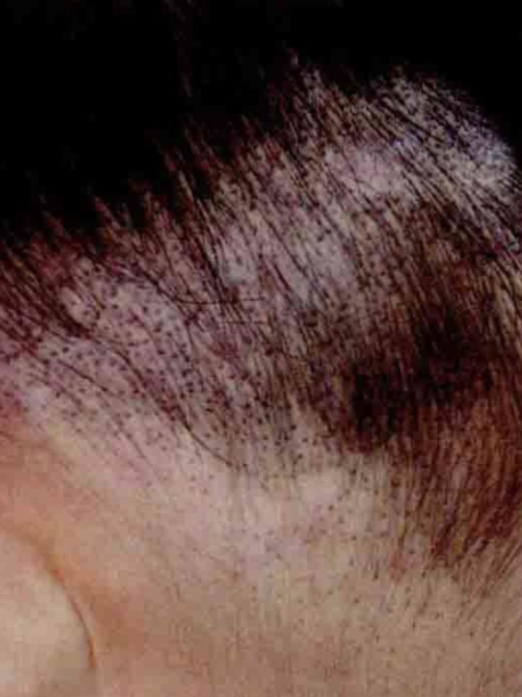 4岁儿童突然脱发严重是怎么回事,4岁儿童脱发严重该怎么办